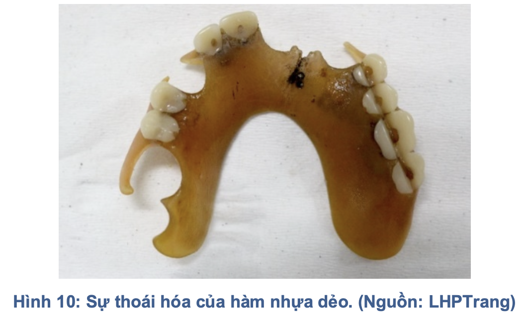 Hàm nhựa dẻo trong phục hình tháo lắp: Đặc tính, chỉ định và biến chứng lâm sàng
